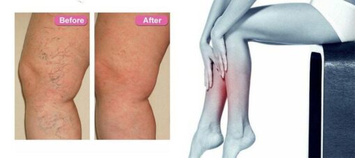 Varicose Vein Skin care lotion